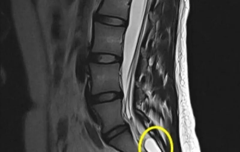 Болит поясница киста. Периневральная ликворная киста s3. Периневральная киста позвоночника поясничного отдела s3. Периневральная киста на уровне s2 позвонка на мрт. Периневральная киста позвоночника поясничного отдела s3 s4.