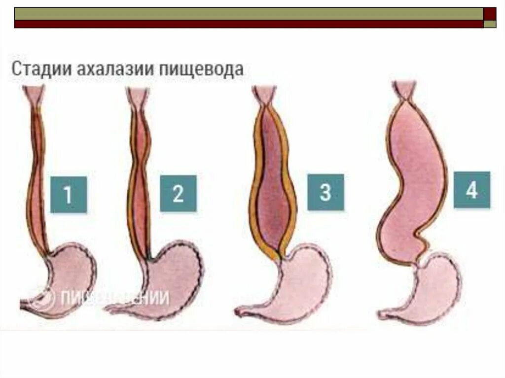 Пищевода 1 степени