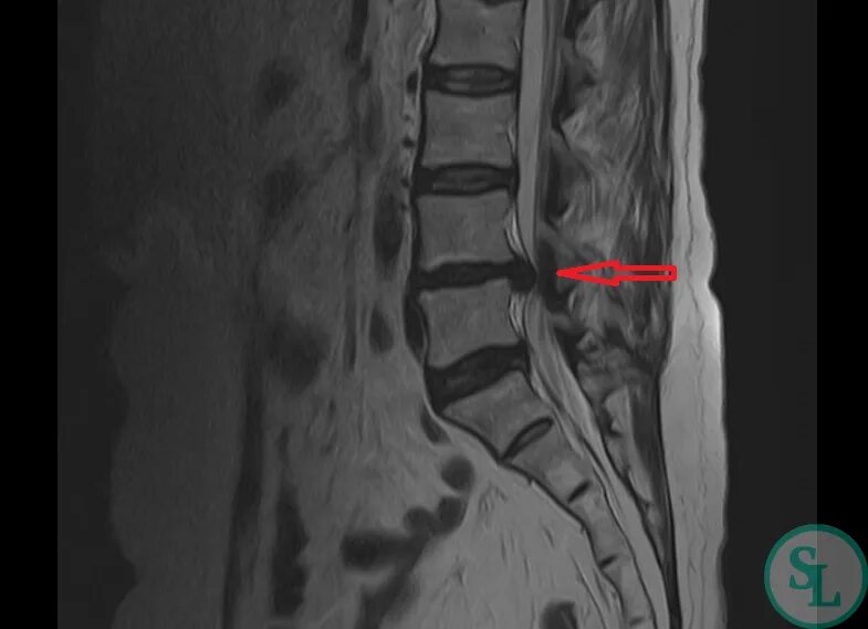 Протрузии межпозвонковых дисков l4 s1. Грыжа диска l4-l5. Грыжа межпозвонкового l4-l5. Протрузия диска l4 l5 что это такое. Грыжа межпозвонкового диска l4-l5.
