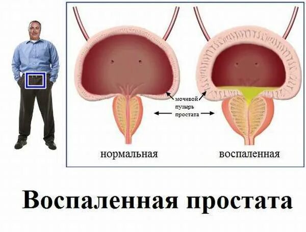 Воспалить простату. Доброкачественная гиперплазия предстательной железы. Воспаление аденомы простаты. Простата нормальная и воспаленная.