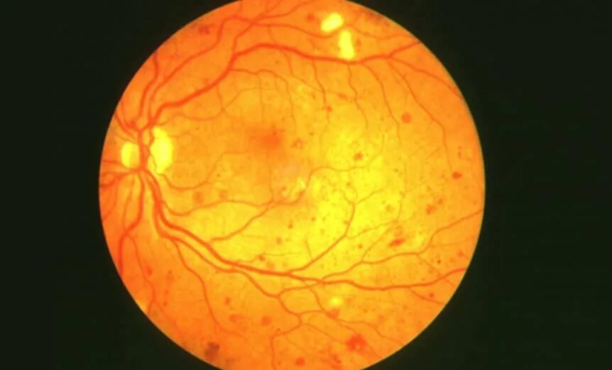 Ангиопатия сосудов мкб. Препролиферативная диабетическая ретинопатия. Диабетическая ретинопатия глаз. Пролиферативная диабетическая ретинопатия глазное дно.