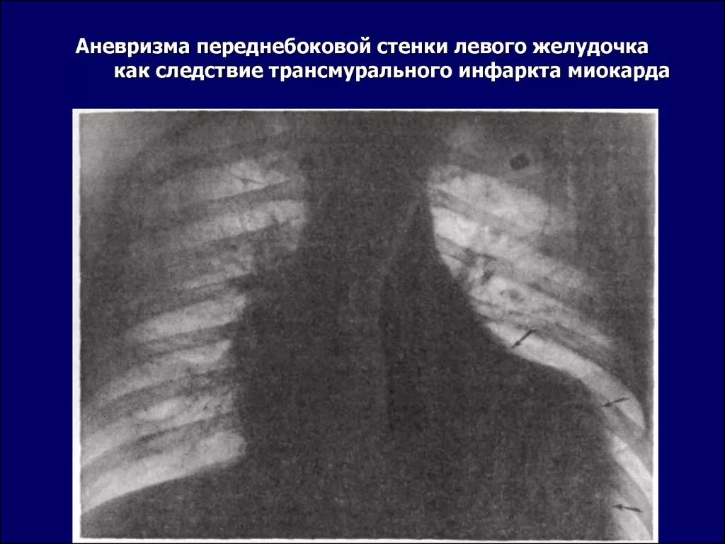 Острый аневризм сердца. Острый трансмуральный переднебоковой инфаркт миокарда. Плоскостная аневризма. Аневризма сердца что это такое симптомы