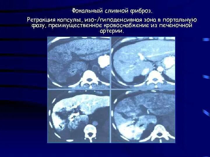 Гиподенсивное образование что это значит