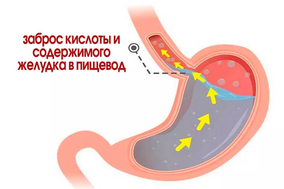 Желудочный сок в пищеводе