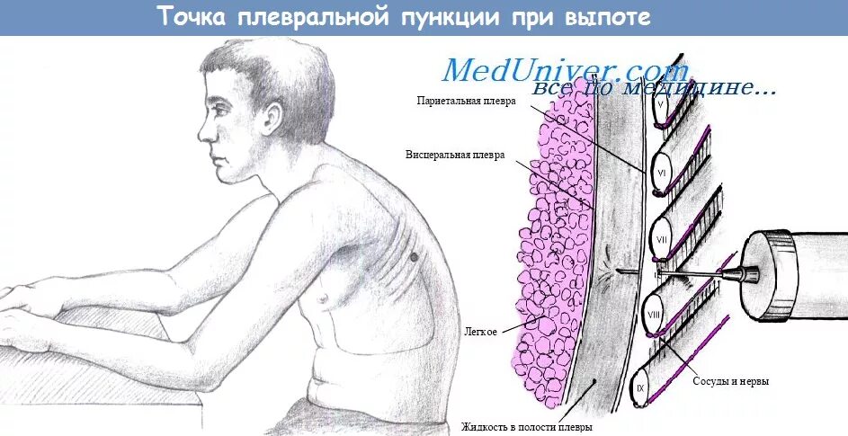 Техника выполнения плевральной пункции. Техника проведения пункции плевры. Техника плевральной пункции при гемотораксе. Пункция плевры при пневмотораксе алгоритм. Техника плевральной пункции при гемотораксе и пневмотораксе..