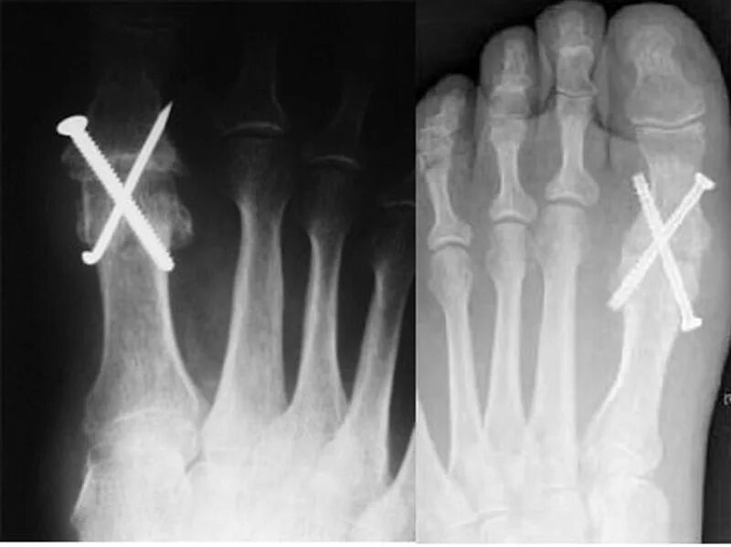 Артродез 1 плюснефалангового сустава. Артродез 1 плюснефалангового сустава винтами. Артрит 1 плюснефалангового сустава рентген. Артроз плюснефалангового сустава рентген. Артродез суставов операция