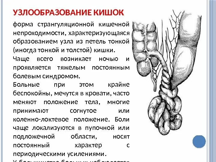 Почему образуются узлы. Кишечная непроходимость узлообразование. Заворот кишок и узлообразование. Узлообразоыание Ари кишечной не проходимости. Непроходимость петля на тонком кишечнике.