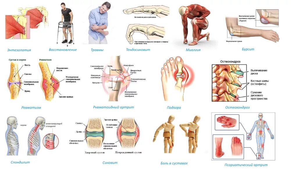 Заболевание опорно двигательный аппарат человека. Травмы опорно-двигательного аппарата. Повреждение опорно двигательной системы. При травмах опорно двигательного аппарата. Болезни опорно двигательной системы человека.