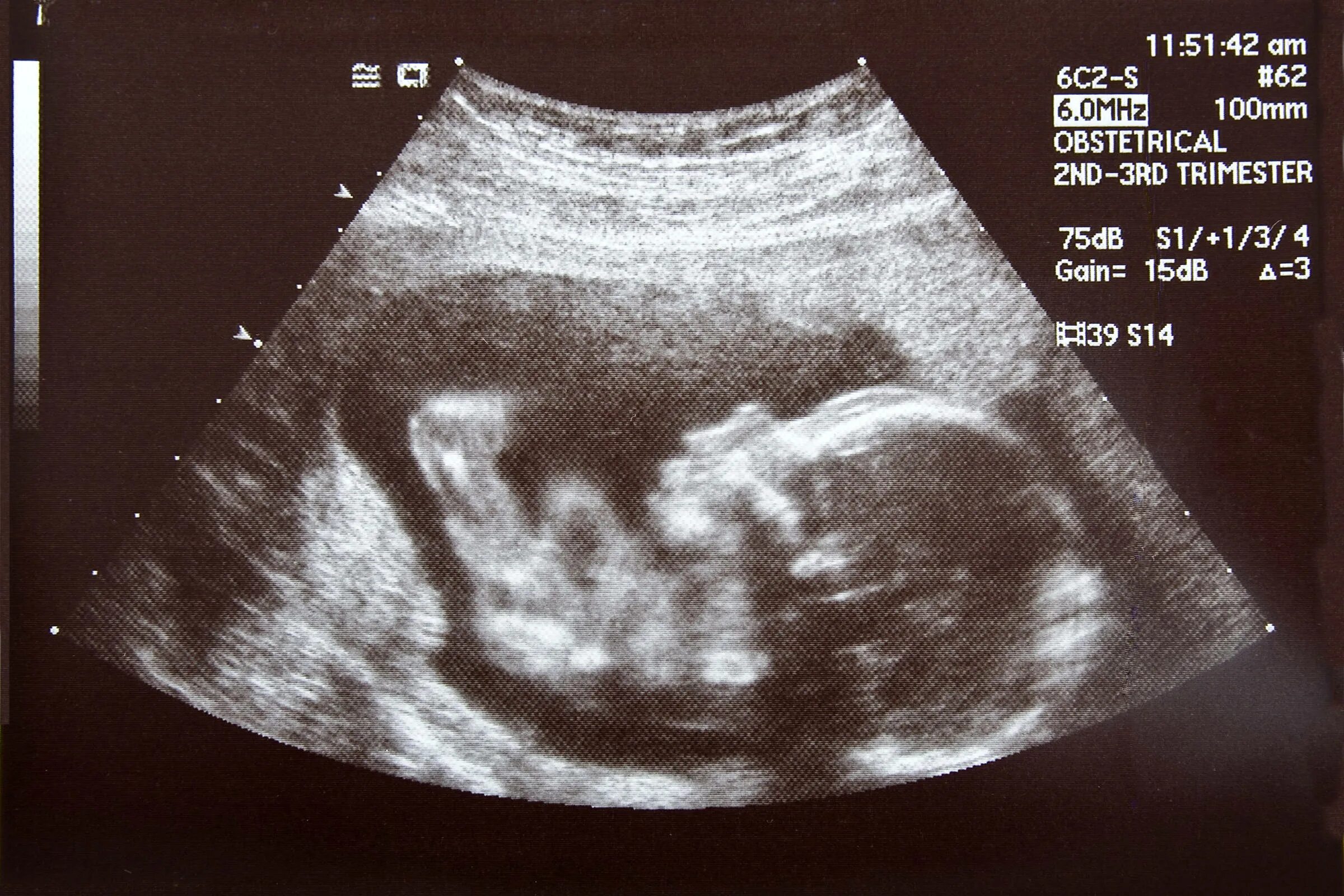 Первые шевеления при первой беременности форум. Плод в 17 недель беременности УЗИ плода. УЗИ ребенка на 17 неделе беременности. УЗИ 16-17 недель беременности. УЗИ ребенка 17 недель УЗИ.