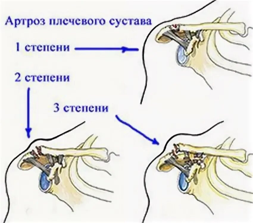 Омартроз степени. Остеоартроз (деформирующий остеоартроз). Деформирующий остеоартроз 3 стадия. Стадии воспаления суставов. Артроз 3 стадии коленного сустава.