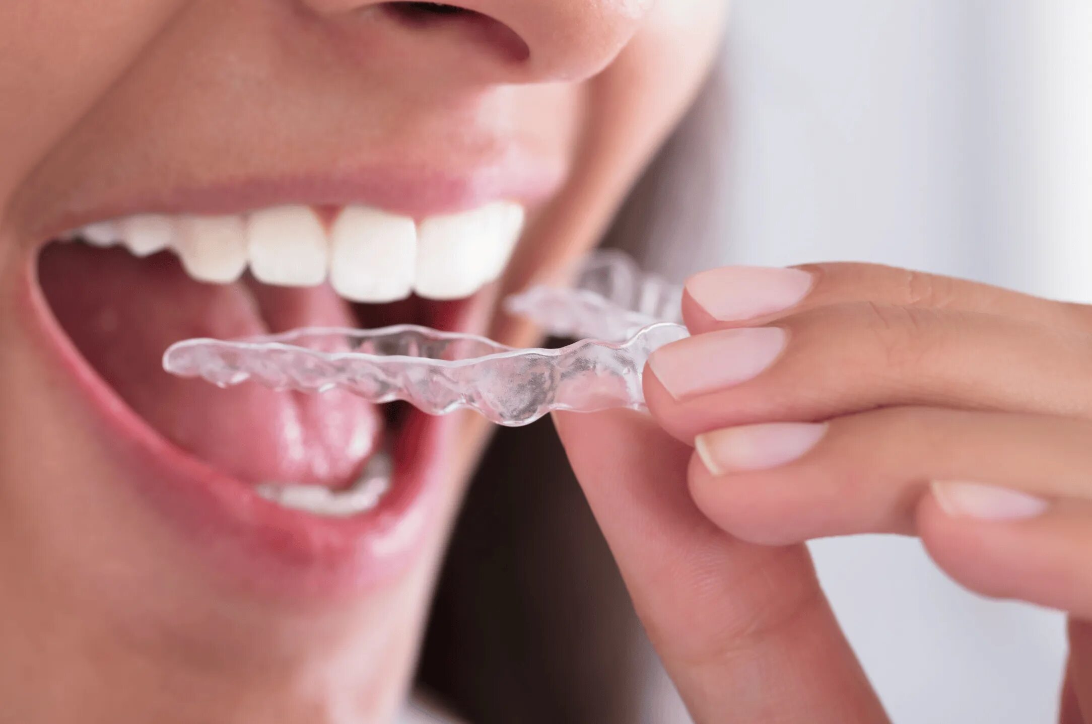 Аксессуары для Invisalign. Ночная Каппа на зубы. Сильно сжатые зубы