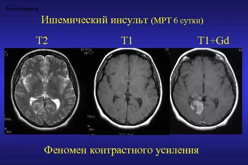 Ишемические изменения мозга. Мрт ишемический инсульт т1. Геморрагический инсульт и ишемический инсульт кт. Геморрагический инсульт головного мозга кт. Ишемический инсульт мозжечка кт.