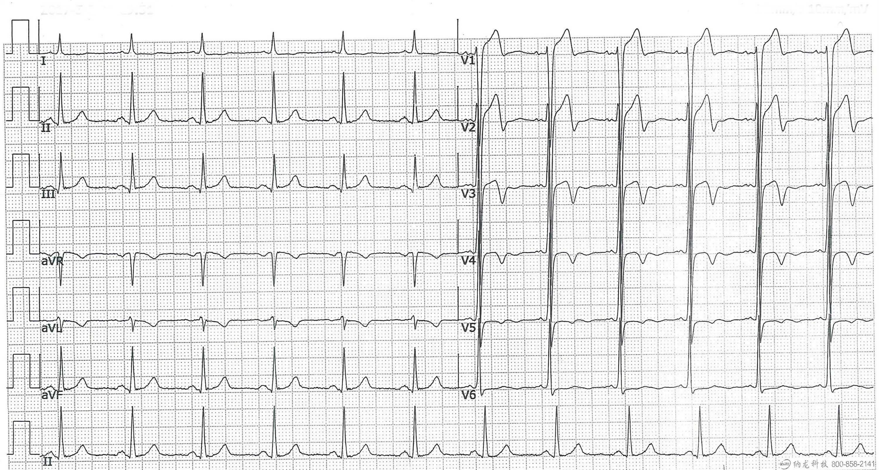 Подъем st в 3. Элевация st на экг v1-v3. элевация это в экг. элевация сегмента st на экг. экг подъем st в v1 v2 v3.