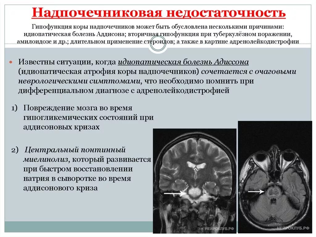 Какие заболевания надпочечников. Недостаточность надпочечников. Недостаточность функции коры надпочечников. Недостаточность надпочечников симптомы. Первичная недостаточность надпочечников.