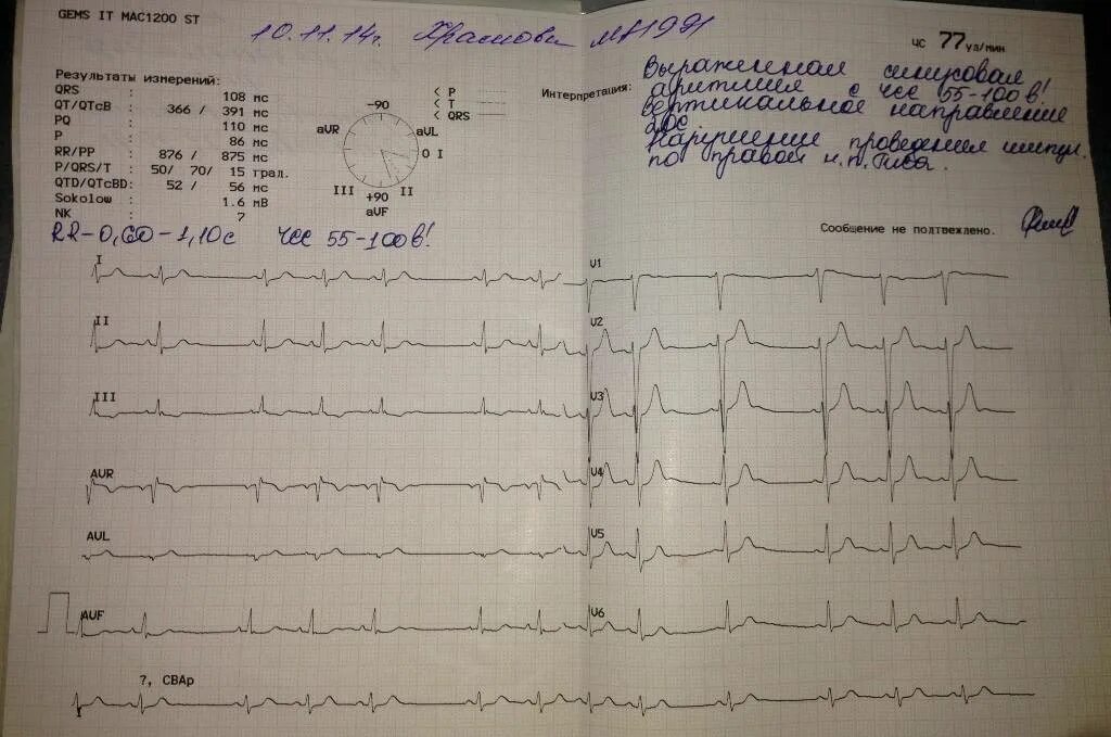 Результат функционального исследования ЭКГ. ЭКГ расшифровка нормальная ЭКГ. Расшифровка ЭКГ В норме пример. Пример нормальной ЭКГ С расшифровкой. Тяжелое экг