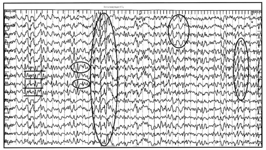 Пик полипик волна на ЭЭГ. Пик медленная волна на ЭЭГ что это. Острые волны на ЭЭГ. Спайк пик волна на ЭЭГ. Диффузная эпилептиформная активность