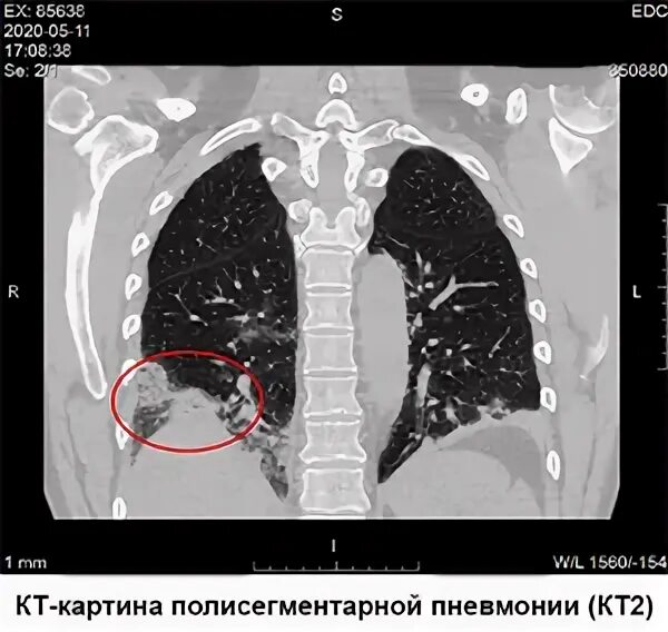 Ковид пневмония кт. Лёгкие при ковид 19 на кт. Кт легких ковид