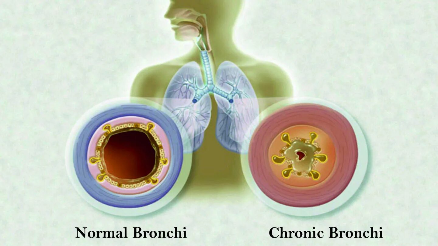 Бронхит 2024. Хронический пылевой бронхит. Обструктивный пылевой бронхит. Токсико пылевой бронхит.
