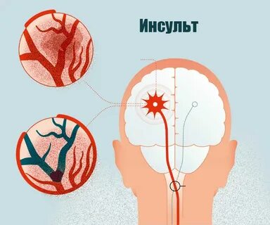 После инсульта болит голова