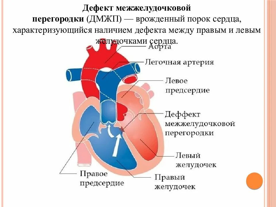 Перегородка в левом предсердии