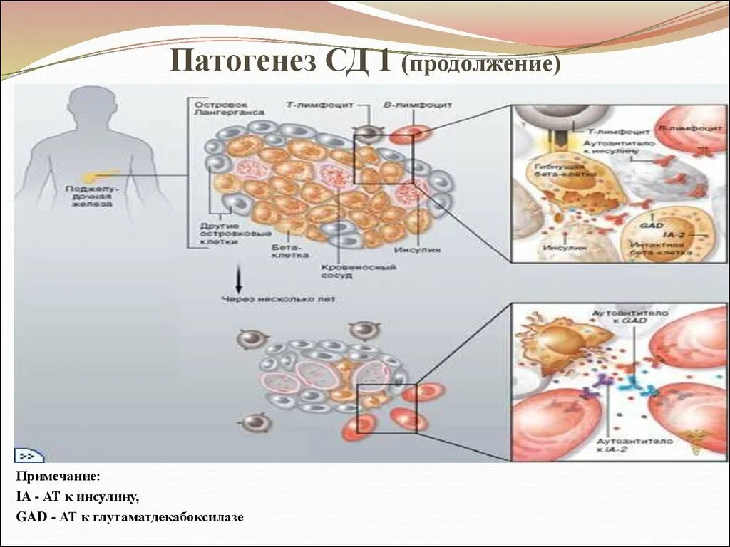 Тема сд. Механизм развития СД 1 типа. Этиология сахарного диабета 1 типа. Механизм развития сахарного диабета 1 типа биохимия. Механизм развития сахарного диабета 1 и 2 типа.