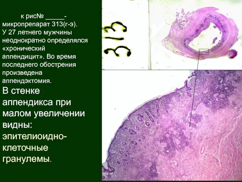 Аппендикс гистология препарат. Аппендикс микропрепарат патанатомия. Флегмонозный Гнойный аппендицит. Хронический аппендицит ми кро.