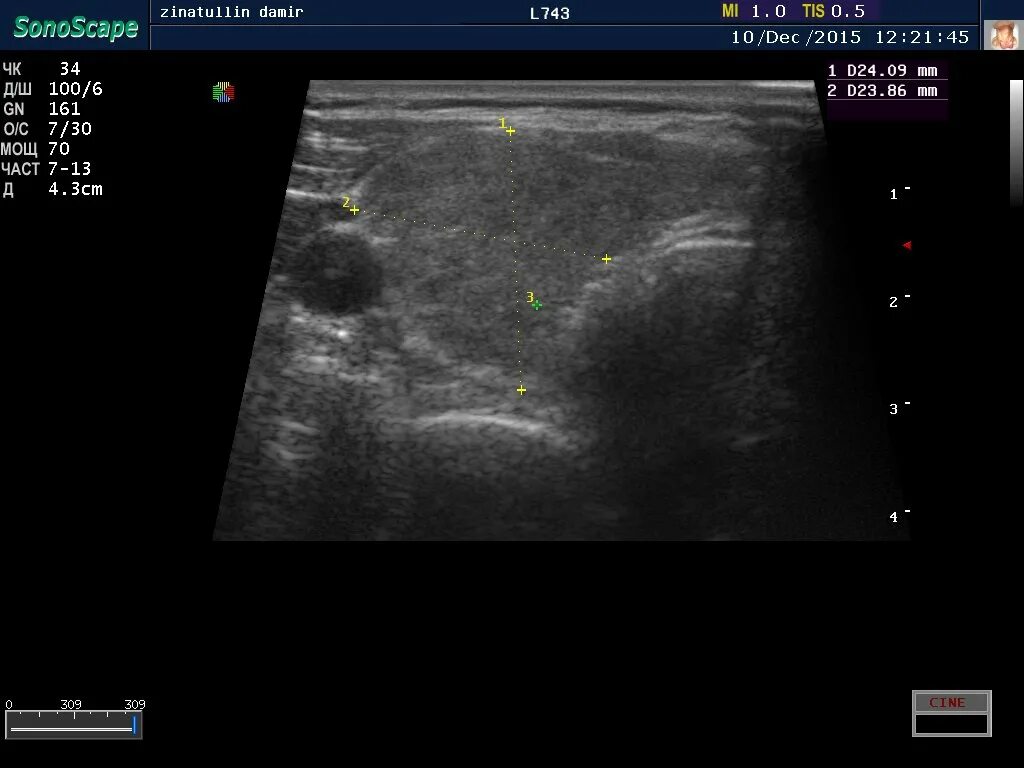 Диффузнотоксичей зоб УЗИ. Диффузно Узловой зоб УЗИ. Диффузный токсический зоб УЗИ. ЦДК кровоток щитовидной железы. Щитовидная железа узи лимфоузлы