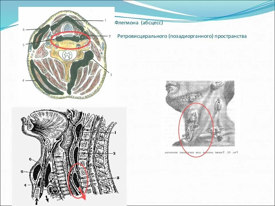 Флегмоны шеи топографическая анатомия. Флегмона ретровисцерального пространства шеи. Топографическая анатомия клетчаточных пространств шеи. Ретровисцеральное клетчаточное пространство шеи.