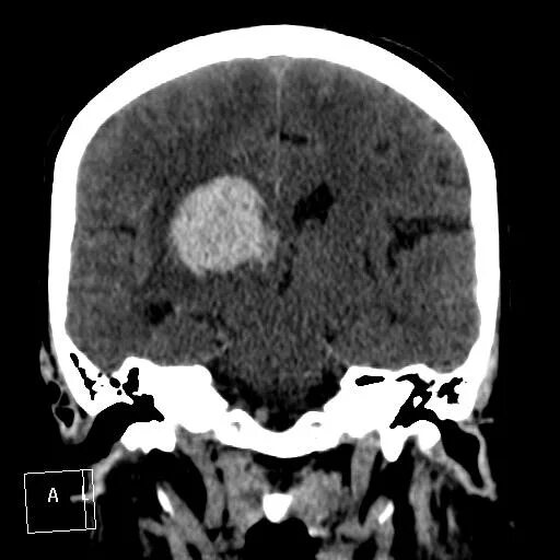 Кровоизлияние в желудочки головного мозга кт. Внутримозговая гематома с прорывом в желудочки кт. Кровь в желудочках мозга кт. Кровоизлияние в третий желудочек на кт. Кровоизлияние в желудочки