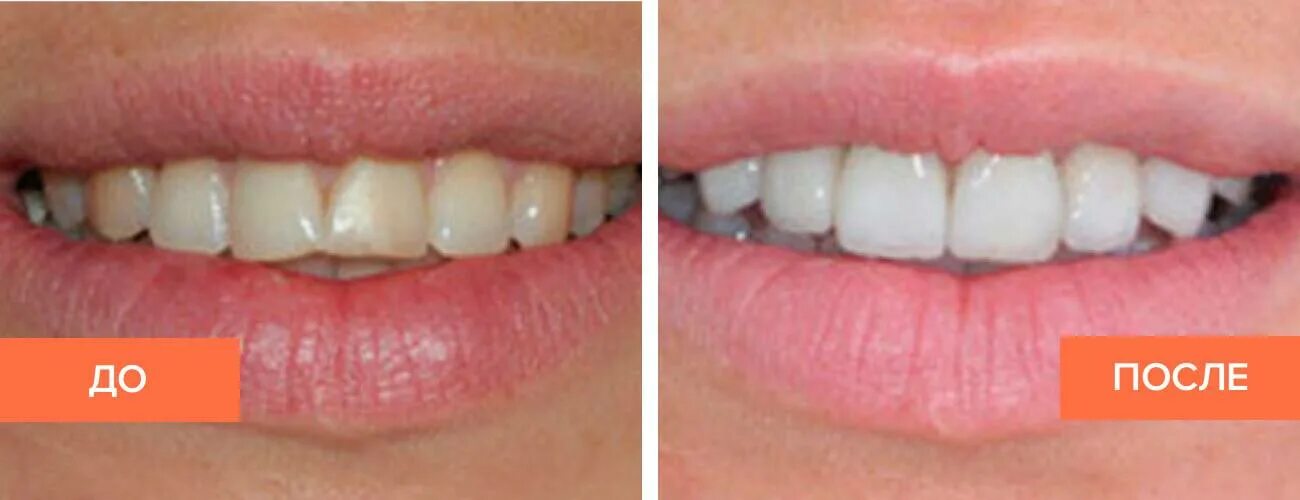 ортодонт мезиальный прикус. мезиальный перекрестный прикус. эмма уотсон прикус. микрогнатия нижней челюсти. 5 мл.