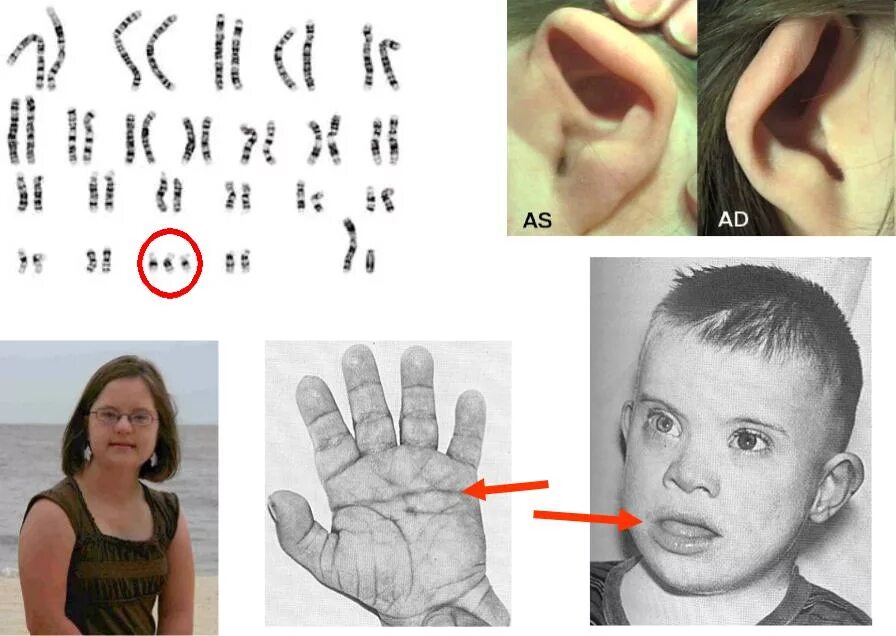 Болезнь дауна является. Фенотипические проявления синдрома Дауна. Внешние проявления синдрома Дауна.