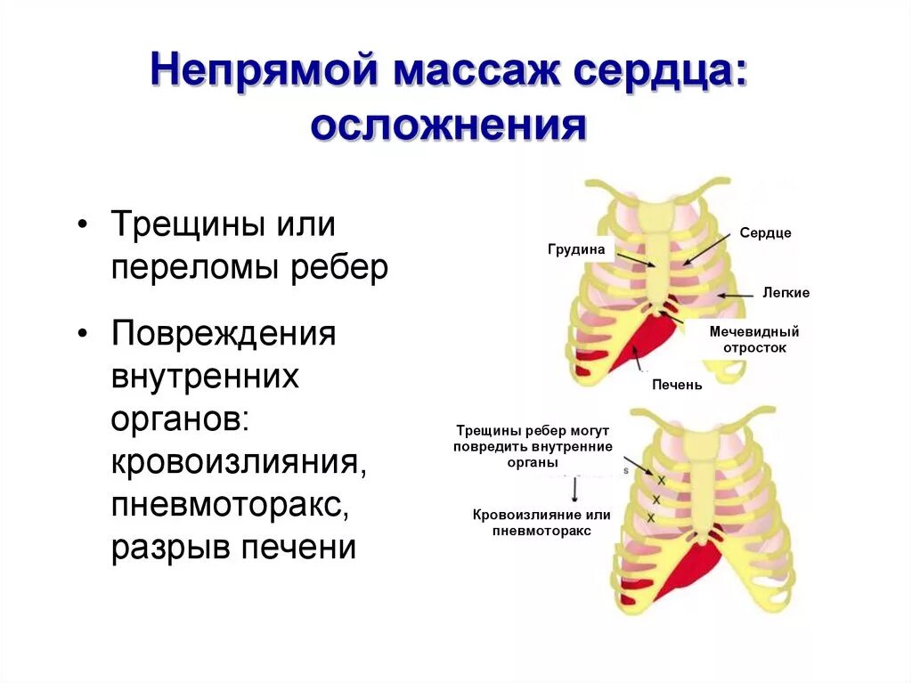 Осложнения слр. Осложнения закрытого массажа сердца. Осложнения непрямого массажа сердца. Осложнения при проведении непрямого массажа сердца. Перелом ребер при непрямом массаже сердца.