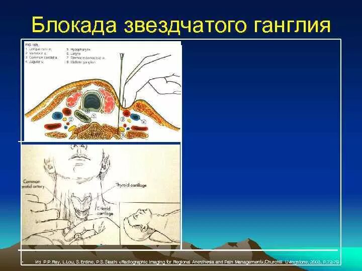 Блокада узла. Блокада симпатических ганглиев. Блокада звездчатого ганглия. Блокада крыловидного ганглий. Блокада звездчатого узла у человека.