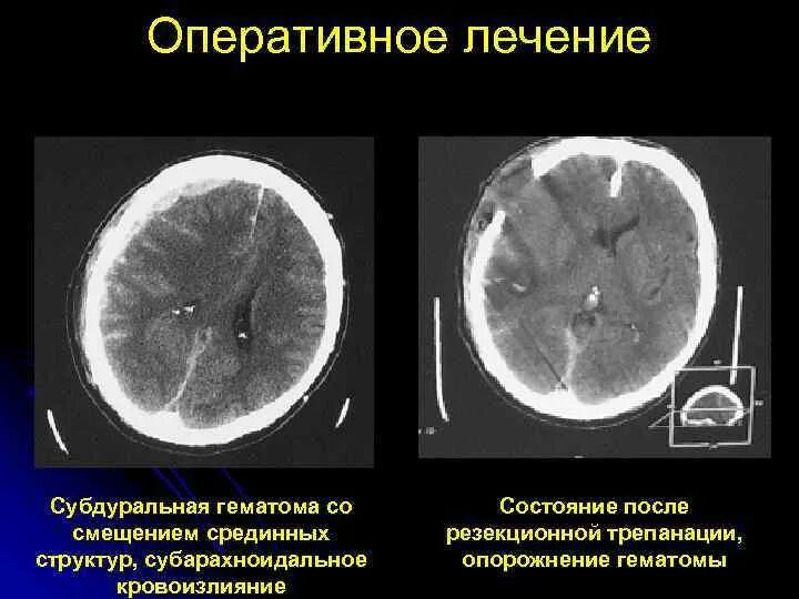 Субарахноидальное субарахноидальное кровоизлияние кт. Субарахноидальное кровоизлияние мозга мрт. Кт субарахноидальное гематома. Субдуральная гематома головного мозга мрт. Гематома мозга операция