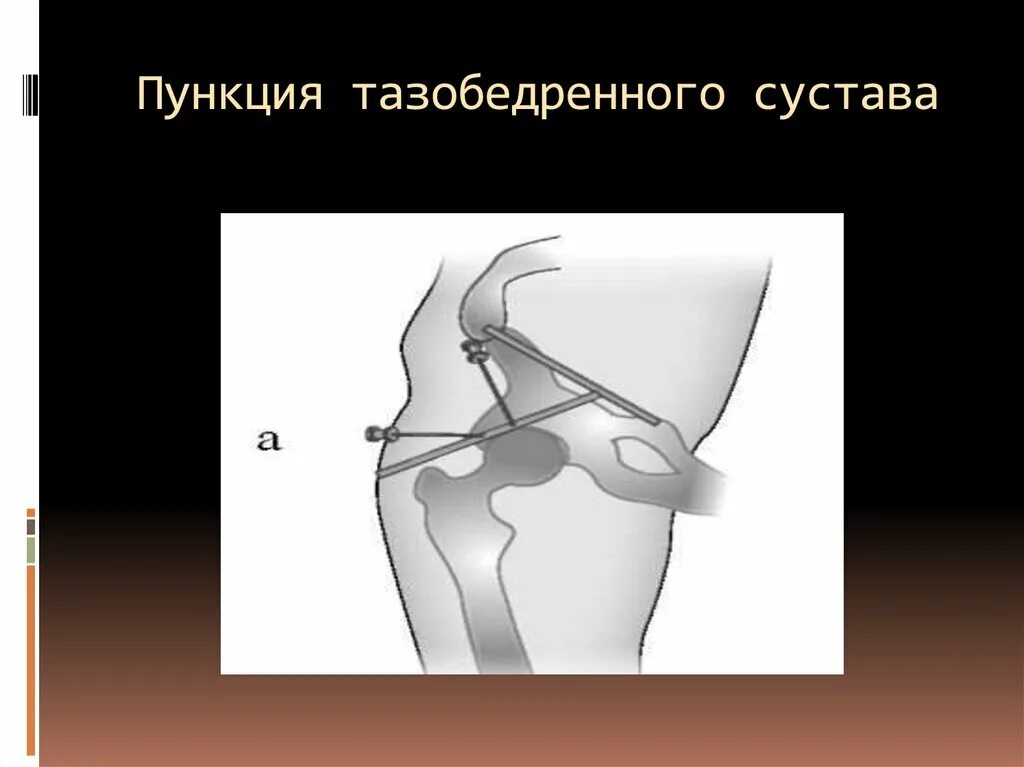 Артротомия плечевого сустава. Пункция и артротомия тазобедренного сустава. Пункция коленного и тазобедренного суставов. Точки пункции коленного сустава.