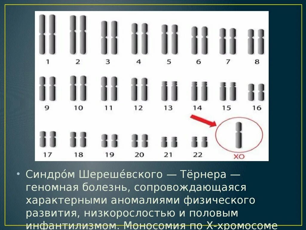 Синдром тернера мкб 10. Хромосомный набор шерешевского тернера. синдром шерешевского тернера кариотип 45х. синдром шерешевского тернера моносомия. моносомия по х-хромосоме синдром шерешевского -тернера кариотип 45 хо.