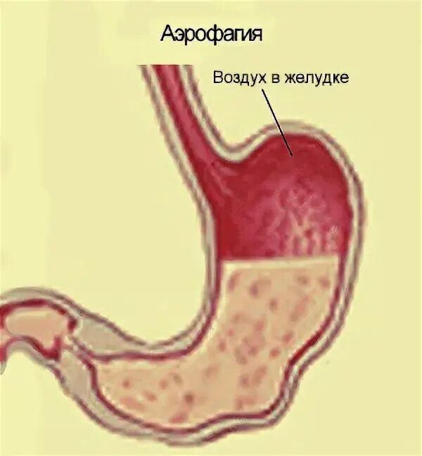 Аэрофагия желудка. Воздушный пузырь желудка. Воздух в области желудка