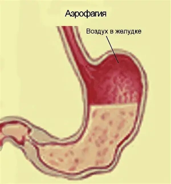 Аэрофагия желудка. Воздушный пузырь желудка. Желудок болит воздуха