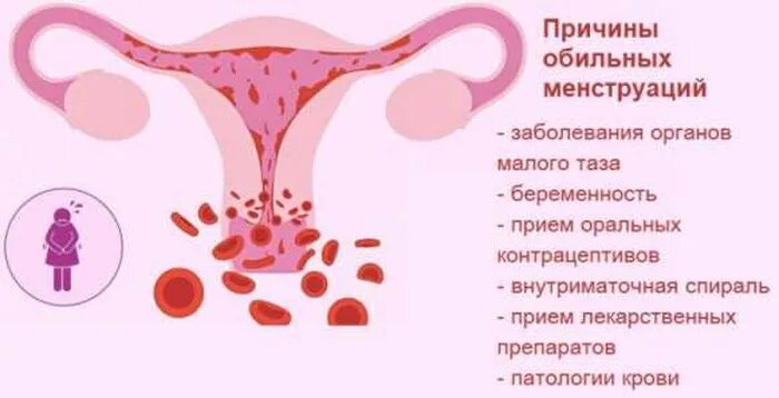 Причины обильных месячных. Менструальное кровотечение.