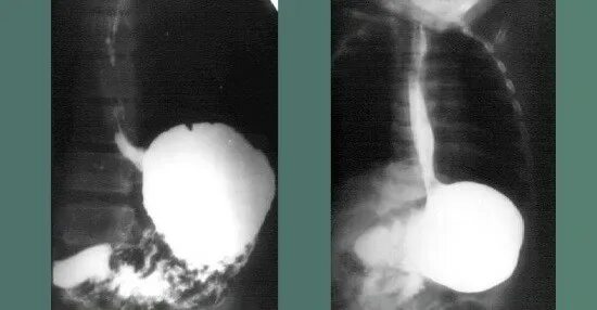 Рентген с барием пищевода и желудка подготовка. Рентген желудка Тренделенбурга. Полип пищевода рентген. Рентген желудка в положении Тренделенбурга.