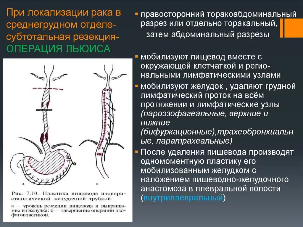 Резекция пищевода по Льюису. Операция Льюиса пищевод. Операция по Льюису на пищеводе. Трансторакальная резекция пищевода. Операция пищевода лечение