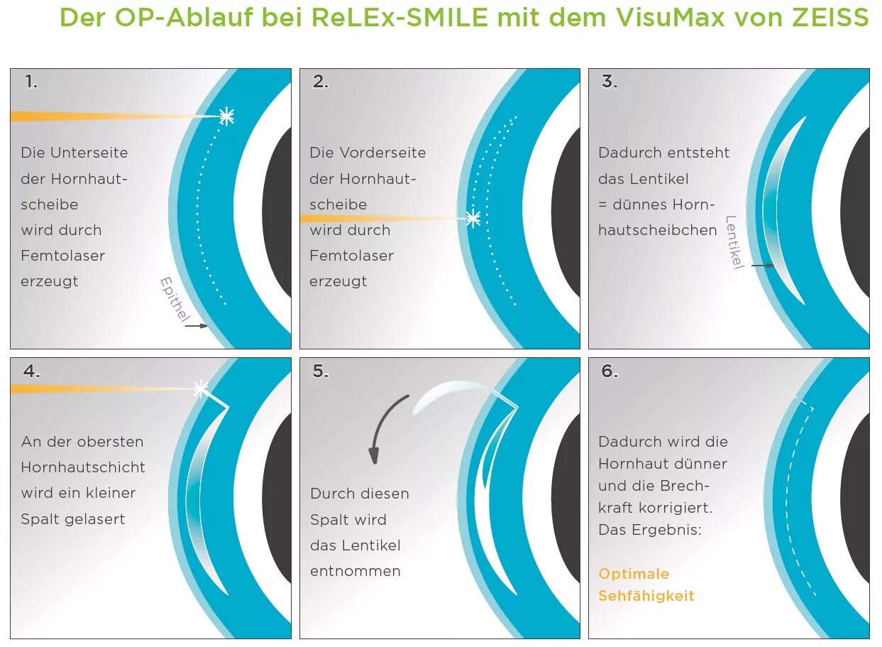 Relex smile clinicaspectr ru. RELEX smile лазерная коррекция зрения. Метод лазерной коррекции RELEX smile. Техника smile коррекция. Лазерная коррекция smile этапы.