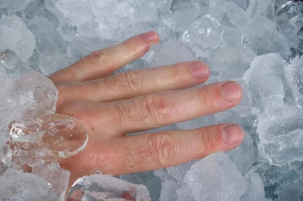 Обморожения степени обморожения. Ледяные руки.