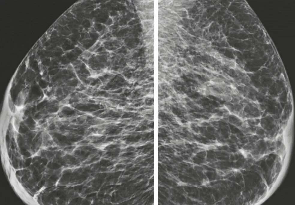 Кистозная мастопатия маммография. Мастопатия молочной железы на маммографии. Маммография фиброзно кистозная мастопатия снимки. Маммография молочных желез фиброз. Диффузно фиброзные изменения молочных желез