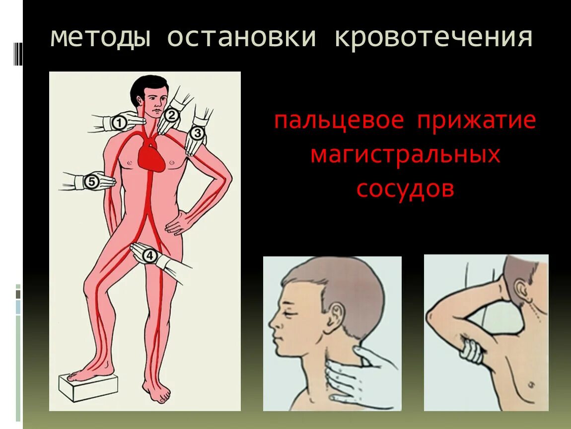 Способы остановки кровотечения. Метод пальцевого прижатия артерий. Методы остановки кровотечений из артерий. Способы Остановить кровотечение.