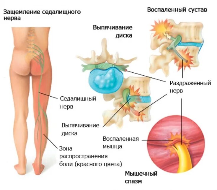 Болят суставы с левой стороны