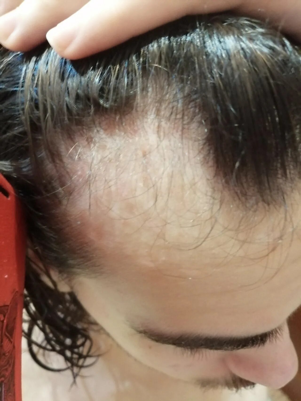 Восстановление выпадения волос. Выпадение волос до и после.