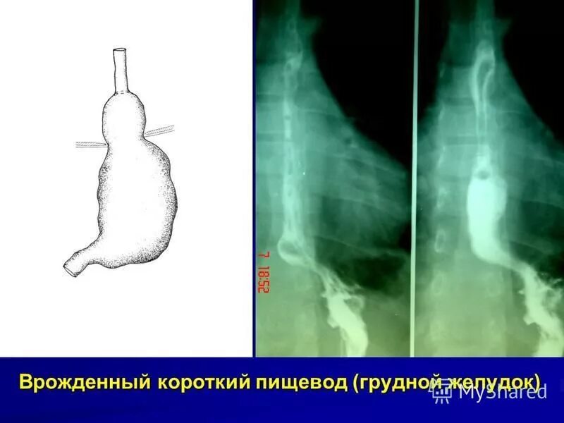 Короткий пищевод. Врожденный короткий пищевод рентген. Грыжа диафрагмы пищевода рентген. Врожденный стеноз пищевода рентген кт.