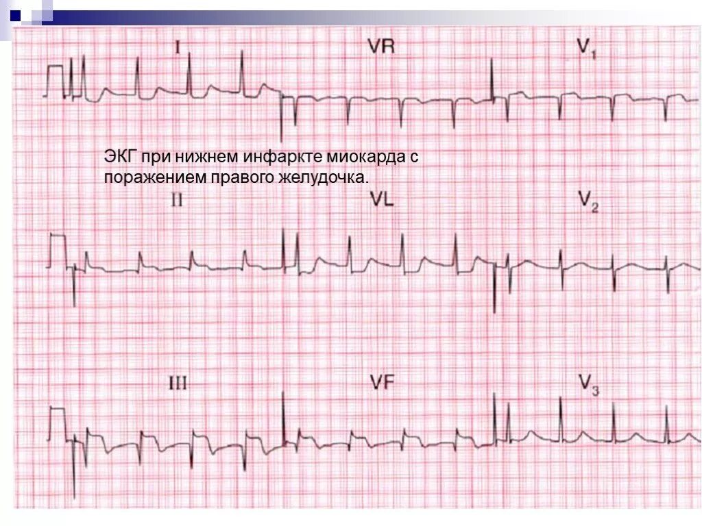 Мв на экг. ОИМ правого желудочка на ЭКГ. Снимок ЭКГ при инфаркте миокарда. Острый инфаркт миокарда правого желудочка на ЭКГ. Нижний инфаркт миокарда на ЭКГ.