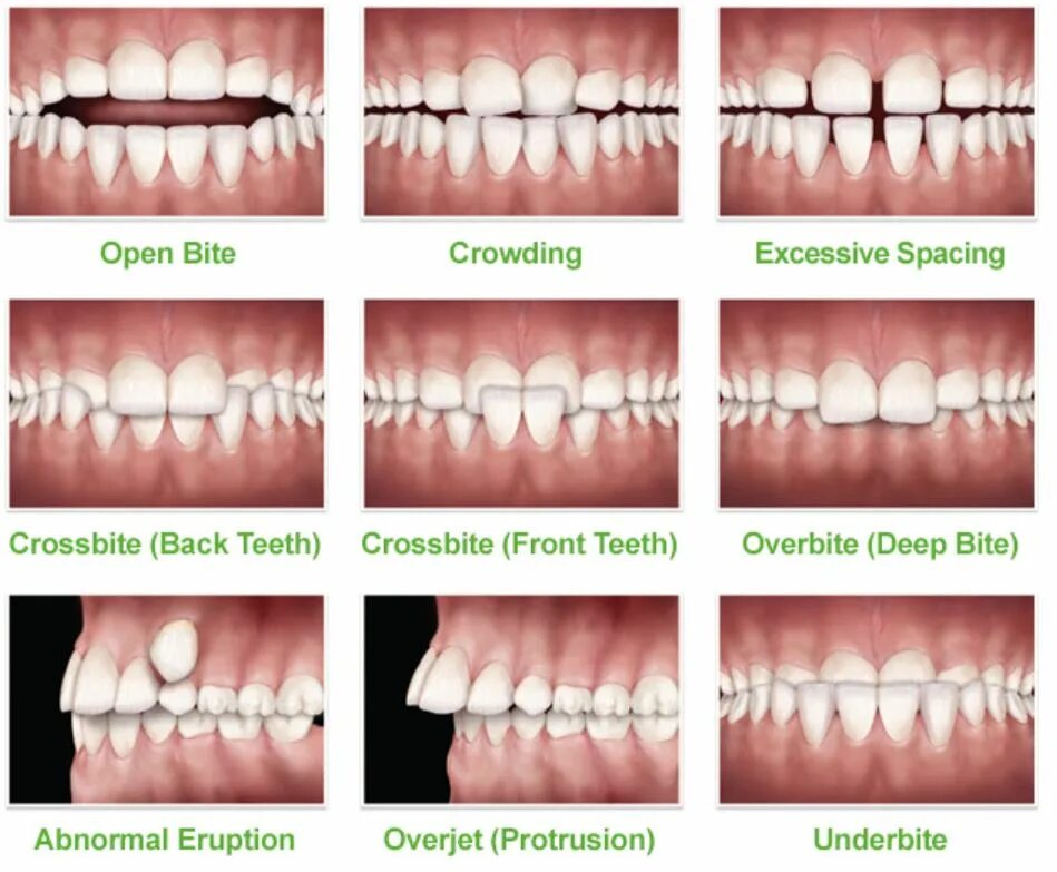 Bite forms